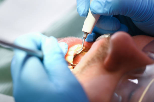 Best Emergency Wisdom Teeth Removal in Richfield, WI
