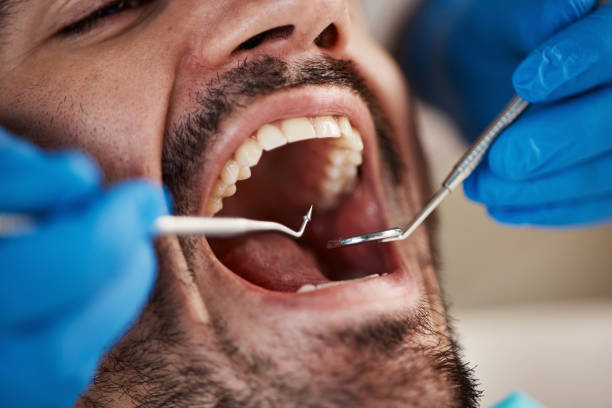 Best Emergency Tooth Extraction in Richfield, WI